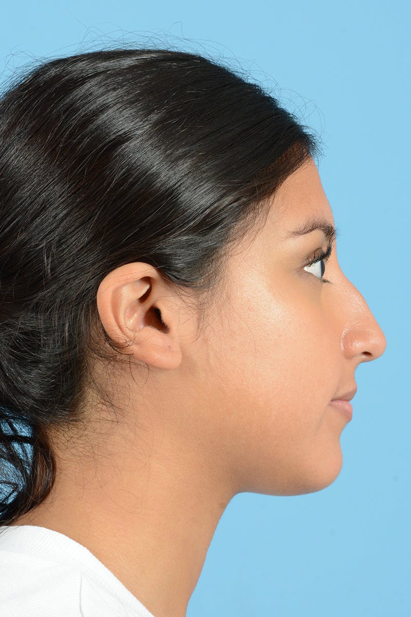 Rhinoplasty Before & After Gallery - Patient 370165 - Image 5