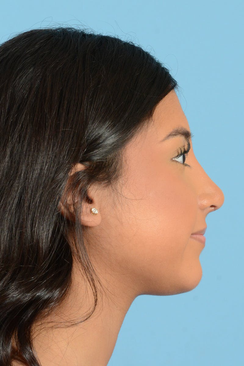 Rhinoplasty Before & After Gallery - Patient 370165 - Image 6