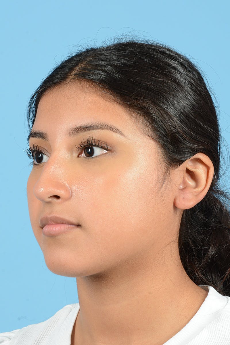 Rhinoplasty Before & After Gallery - Patient 370165 - Image 7
