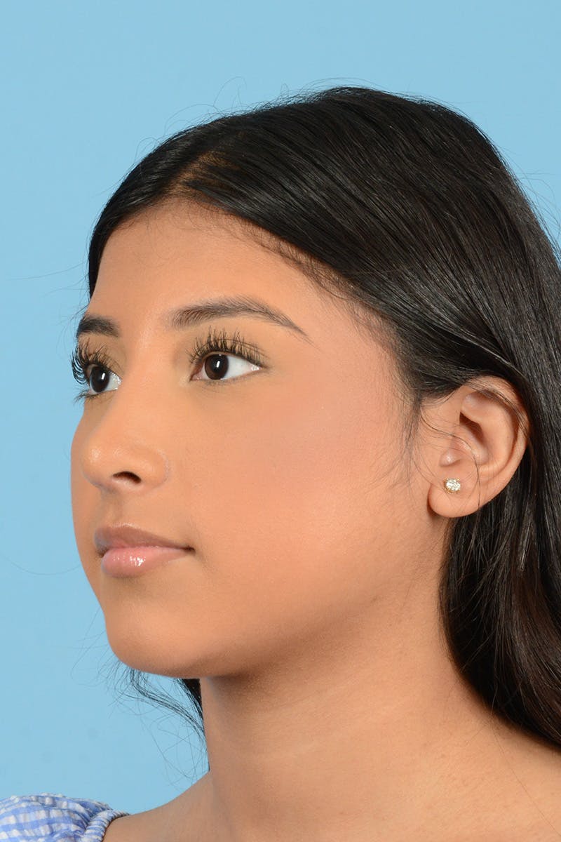 Rhinoplasty Before & After Gallery - Patient 370165 - Image 8