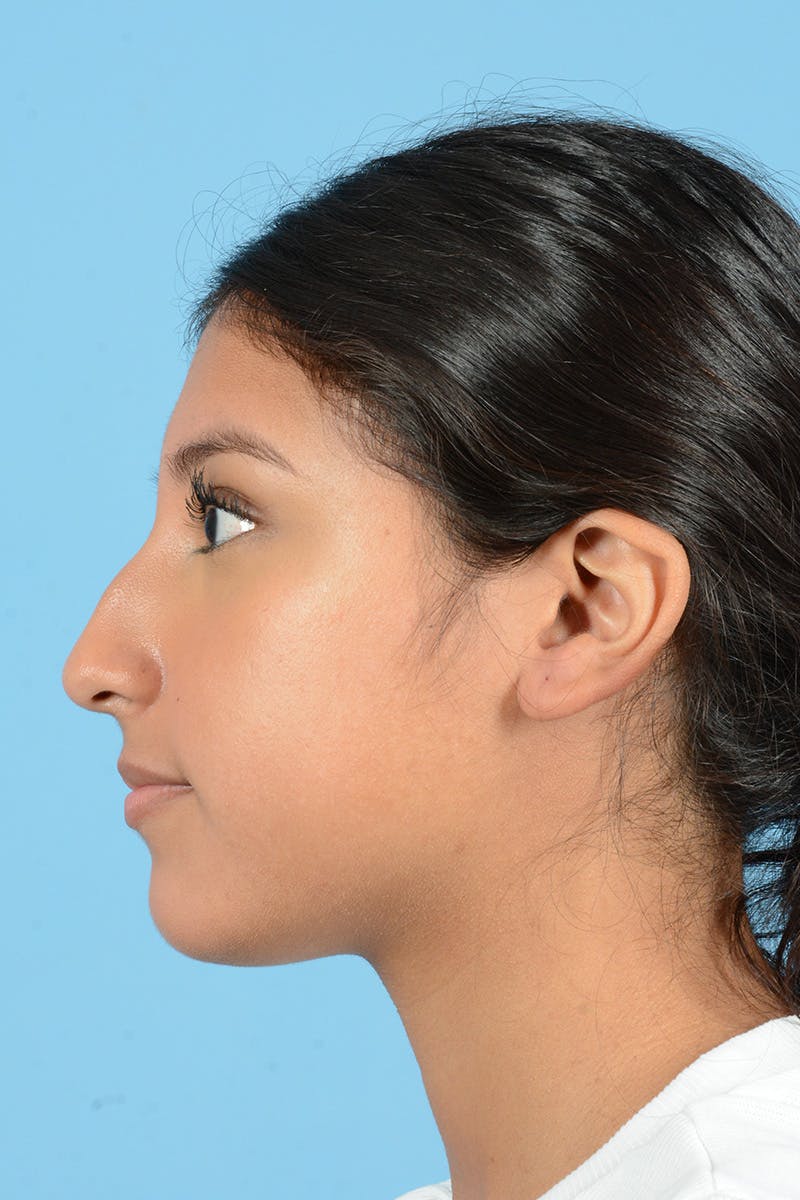 Rhinoplasty Before & After Gallery - Patient 370165 - Image 9