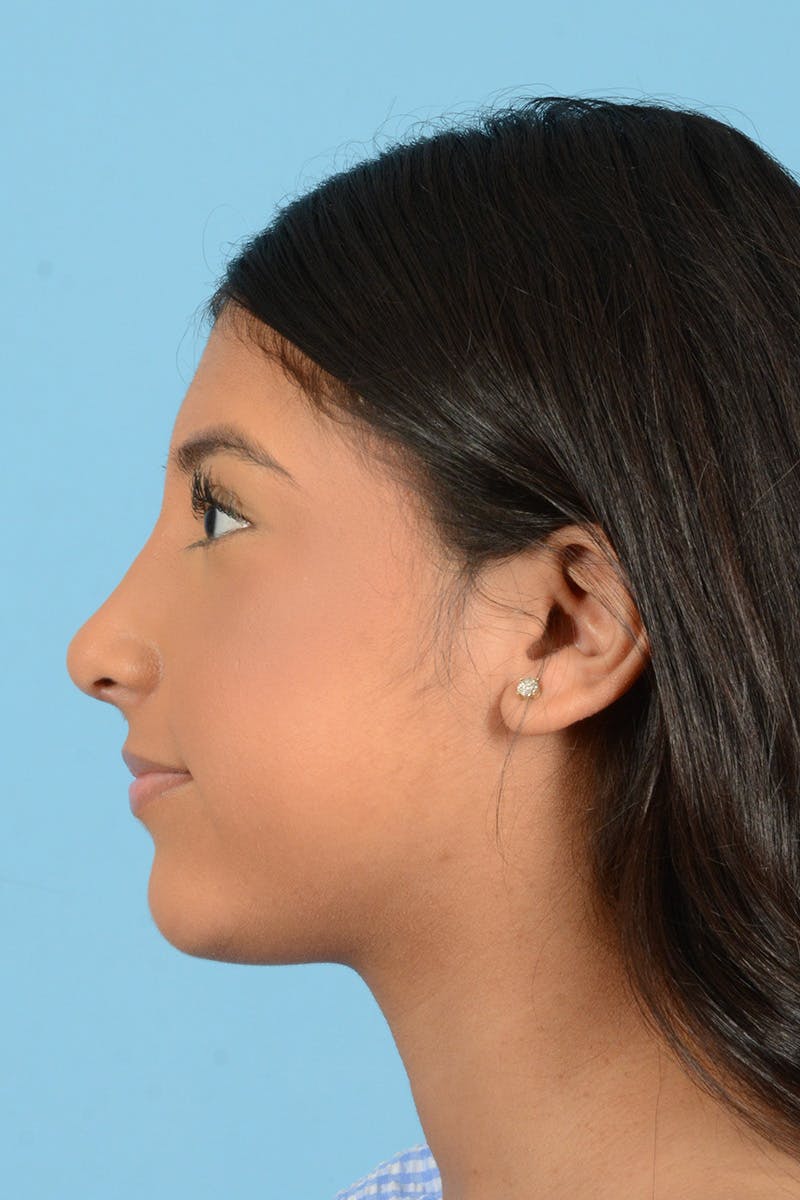 Rhinoplasty Before & After Gallery - Patient 370165 - Image 10