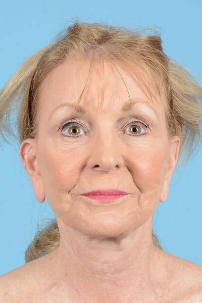 Eyelid Lift Before & After Gallery - Patient 384094 - Image 1