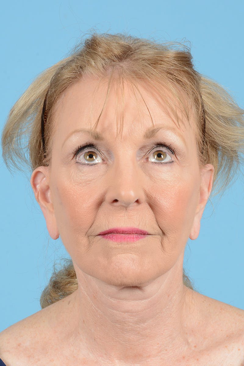 Eyelid Lift Before & After Gallery - Patient 384094 - Image 3