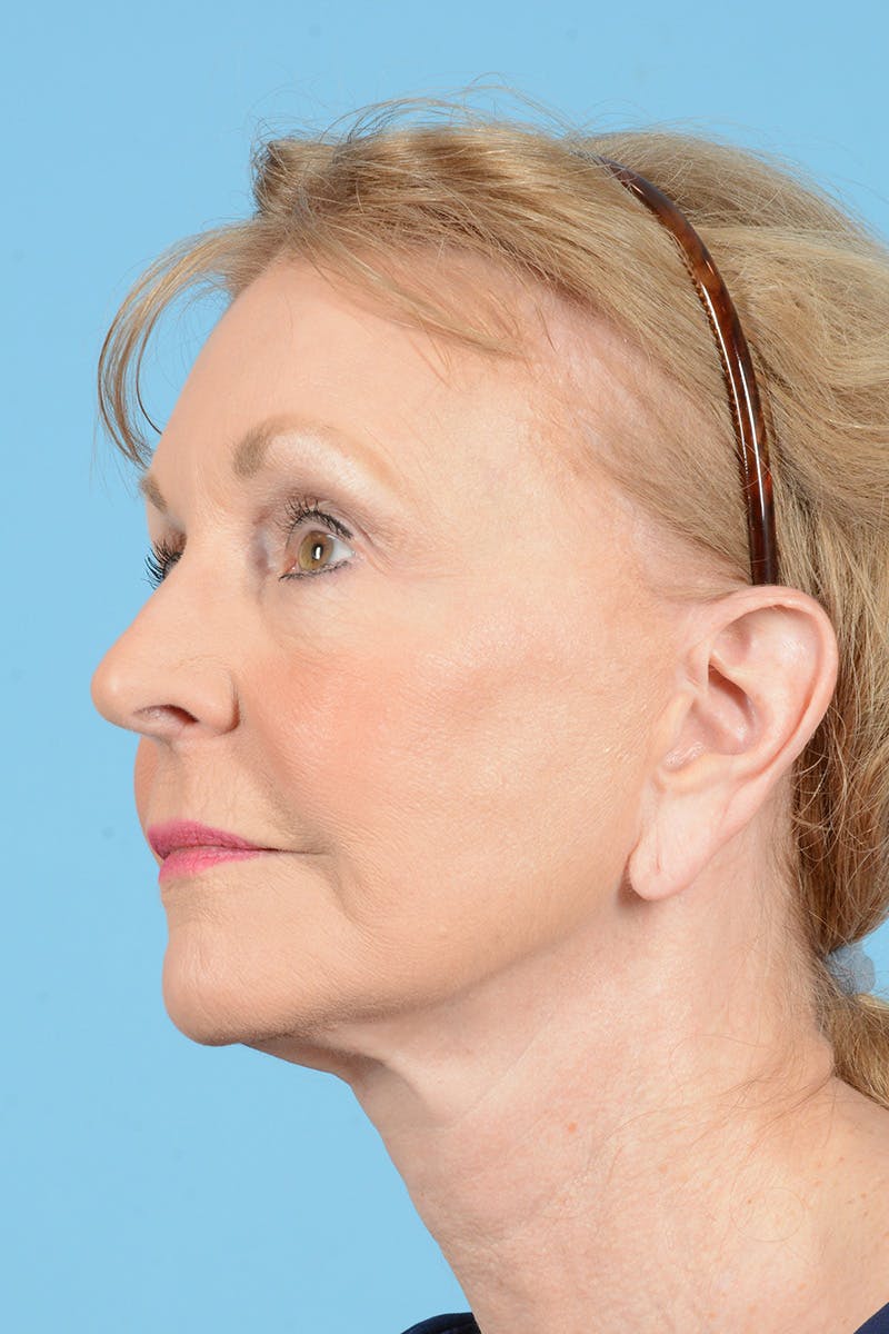 Eyelid Lift Before & After Gallery - Patient 384094 - Image 5
