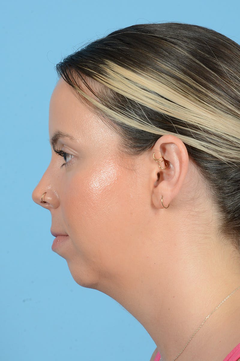 Facial Augmentation Before & After Gallery - Patient 152789 - Image 9