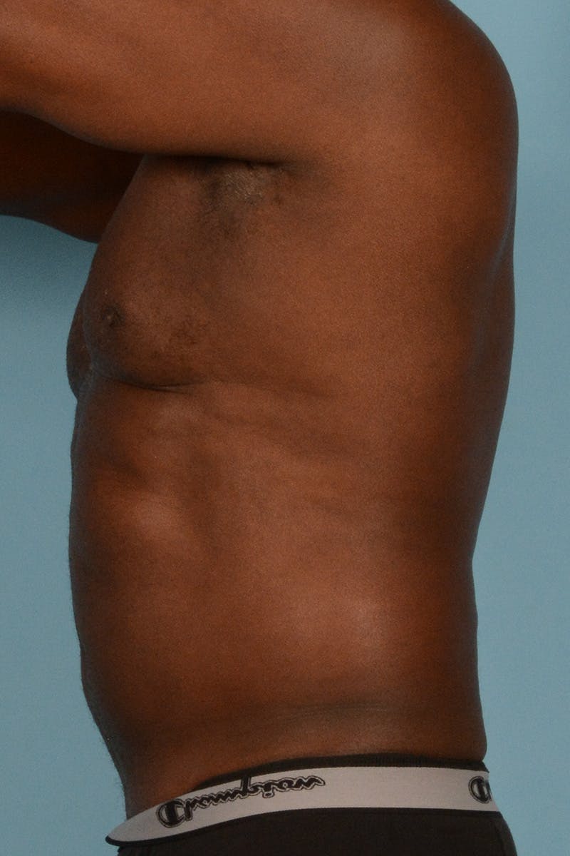 Abdominal Etching Before & After Gallery - Patient 336045 - Image 13
