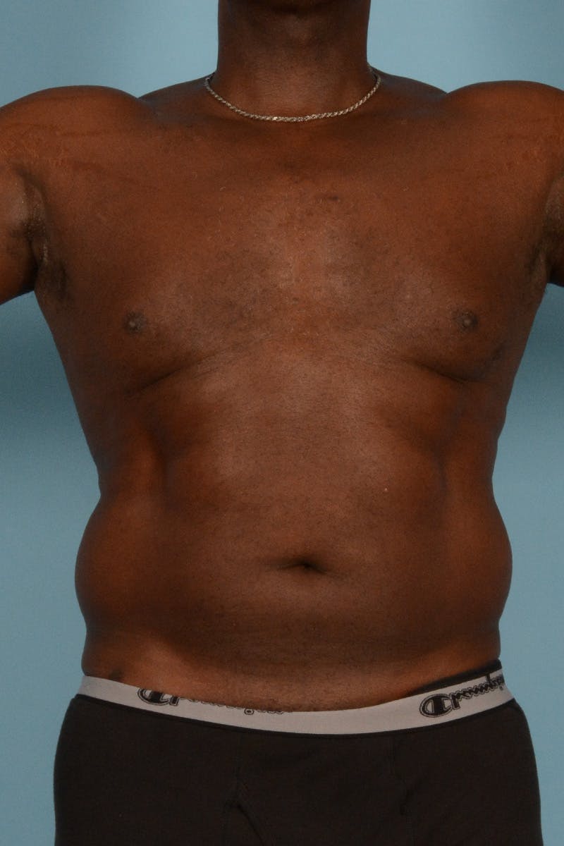 Abdominal Etching Before & After Gallery - Patient 336045 - Image 1