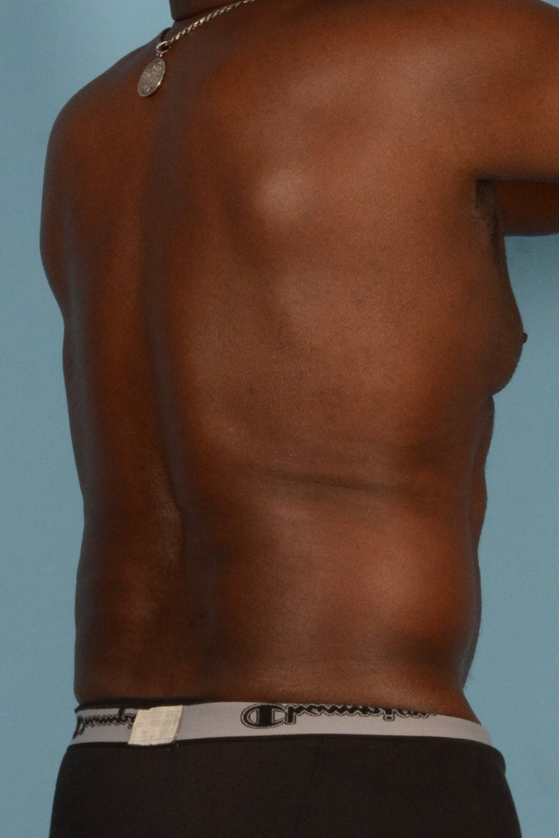 Abdominal Etching Before & After Gallery - Patient 336045 - Image 7