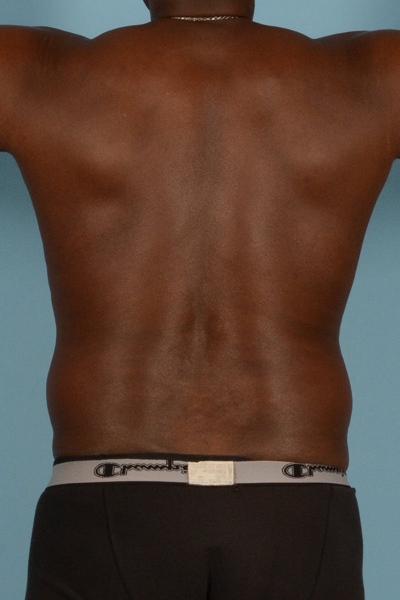 Abdominal Etching Before & After Gallery - Patient 336045 - Image 9