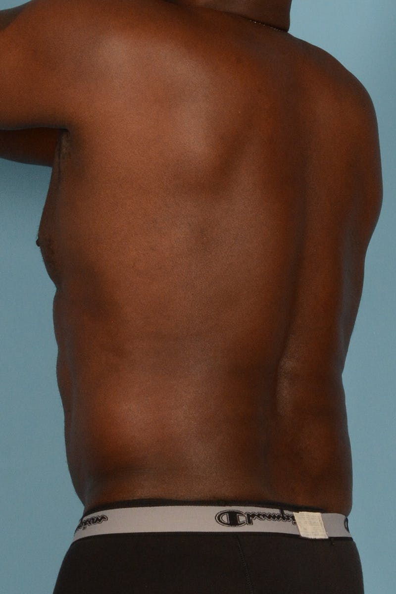 Abdominal Etching Before & After Gallery - Patient 336045 - Image 11