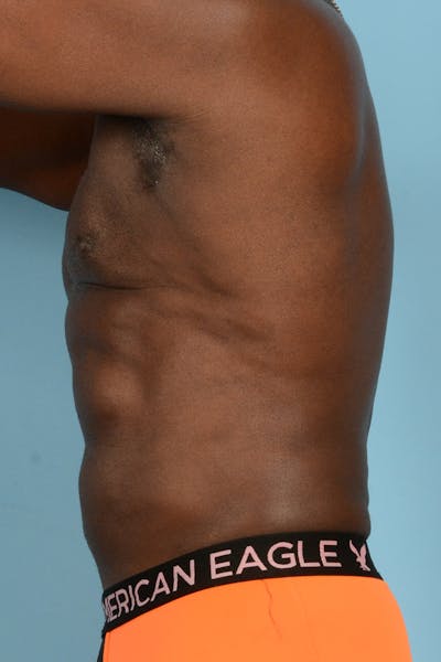 Liposuction Before & After Gallery - Patient 163392 - Image 14