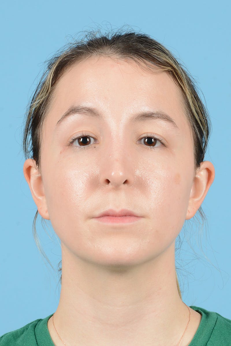 Rhinoplasty Before & After Gallery - Patient 291692 - Image 2