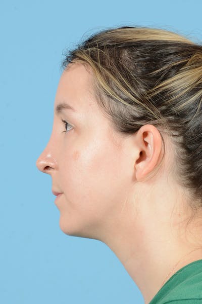 Rhinoplasty Before & After Gallery - Patient 291692 - Image 10