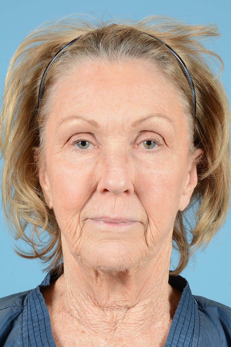 Neck Lift Before & After Gallery - Patient 427610 - Image 1