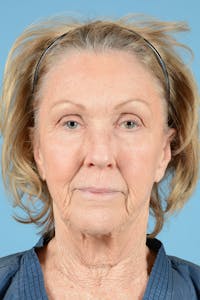 Facelift Before & After Gallery - Patient 431381 - Image 1