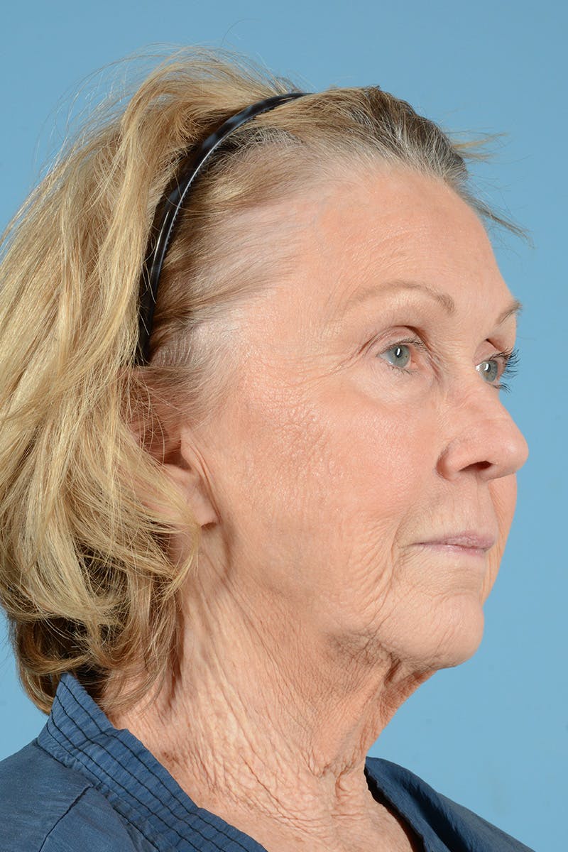 Neck Lift Before & After Gallery - Patient 427610 - Image 3