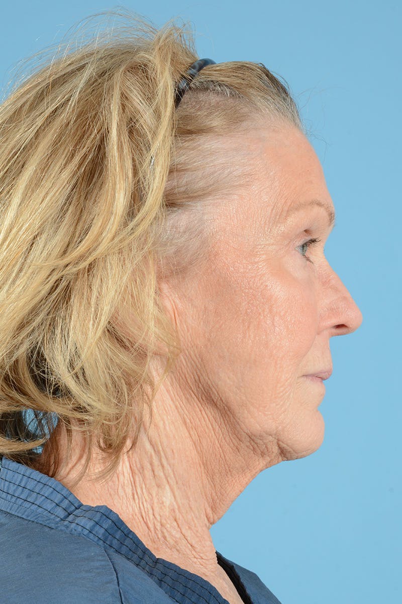Facelift Before & After Gallery - Patient 431381 - Image 5