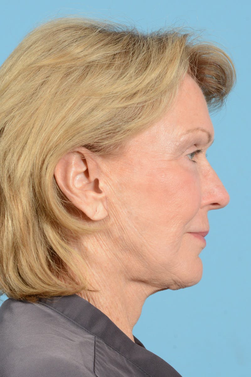 Facelift Before & After Gallery - Patient 431381 - Image 6