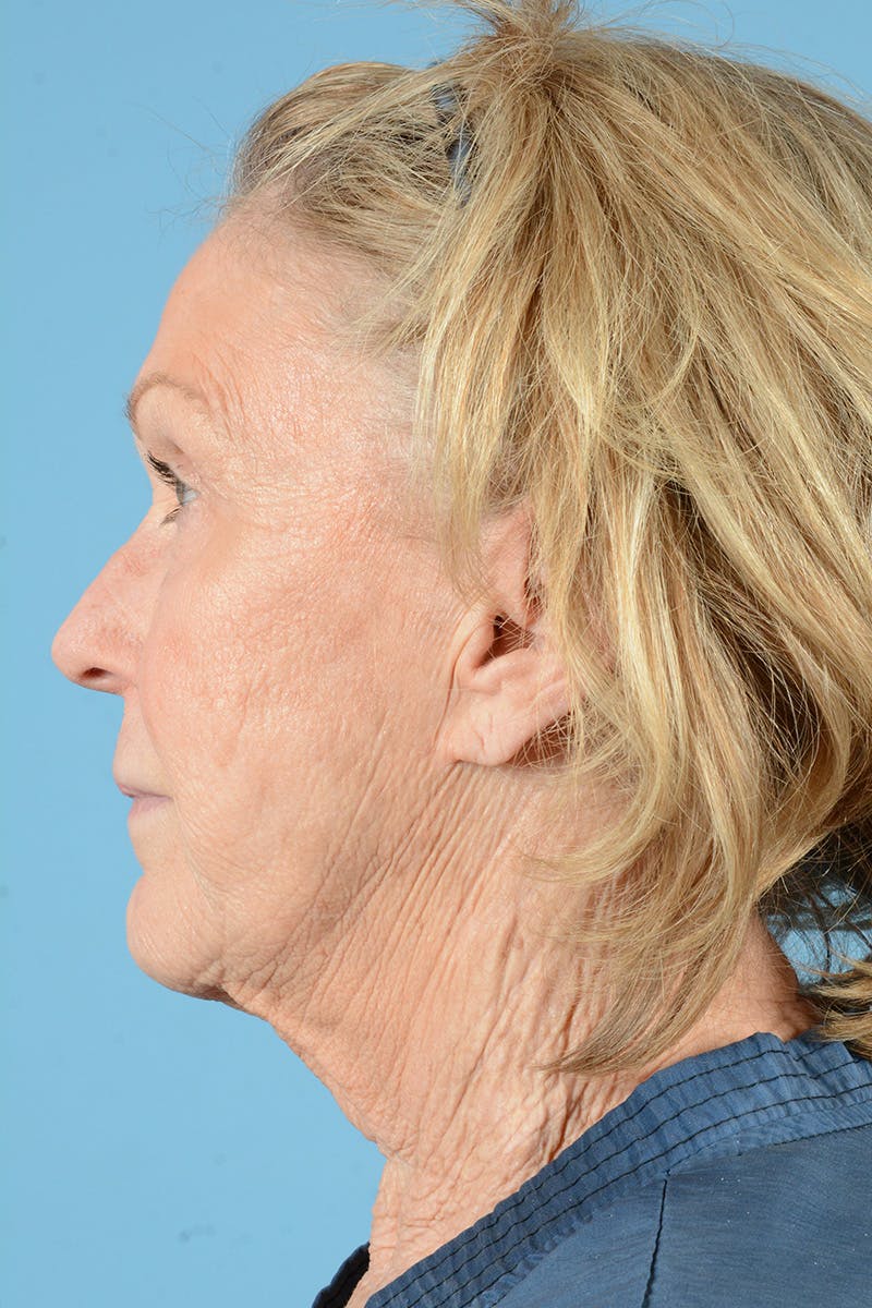 Neck Lift Before & After Gallery - Patient 427610 - Image 9