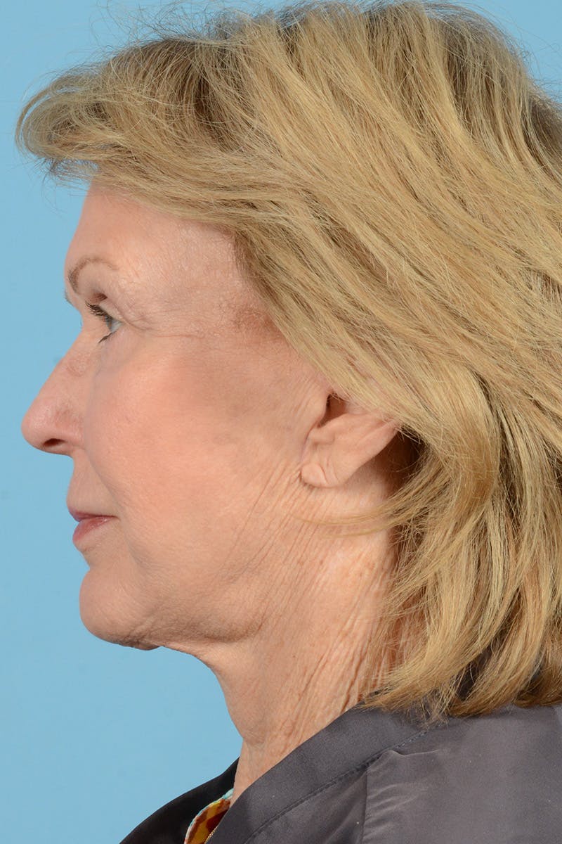 Facelift Before & After Gallery - Patient 431381 - Image 10