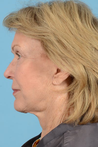Neck Lift Before & After Gallery - Patient 427610 - Image 10