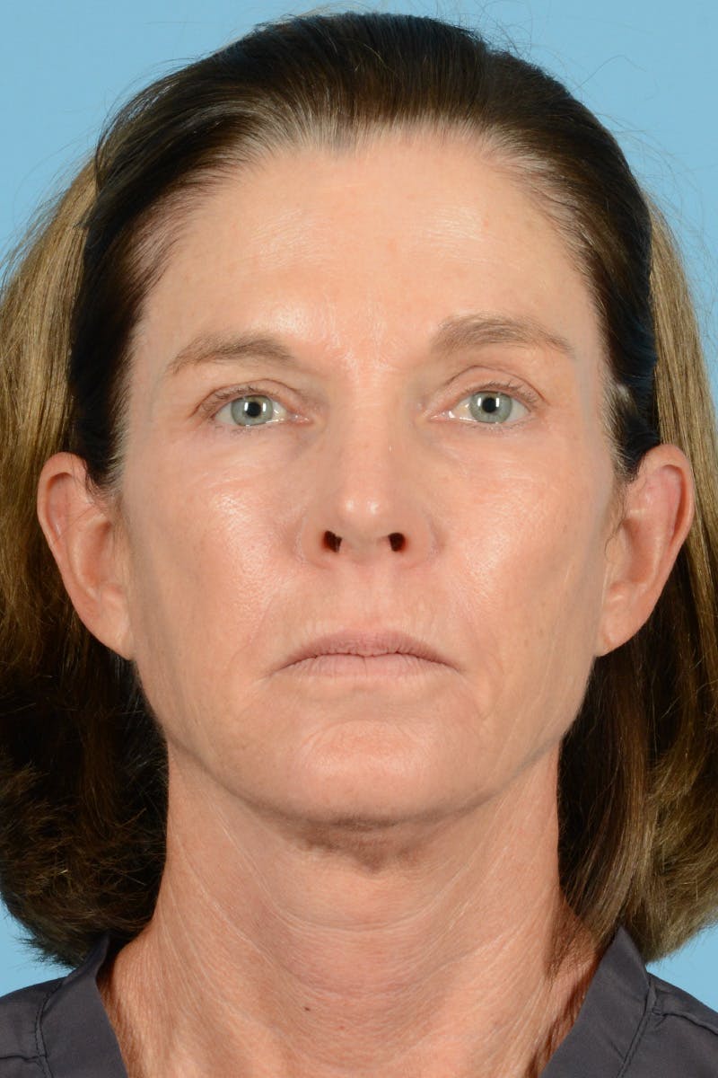 Brow Lift Before & After Gallery - Patient 144248 - Image 1