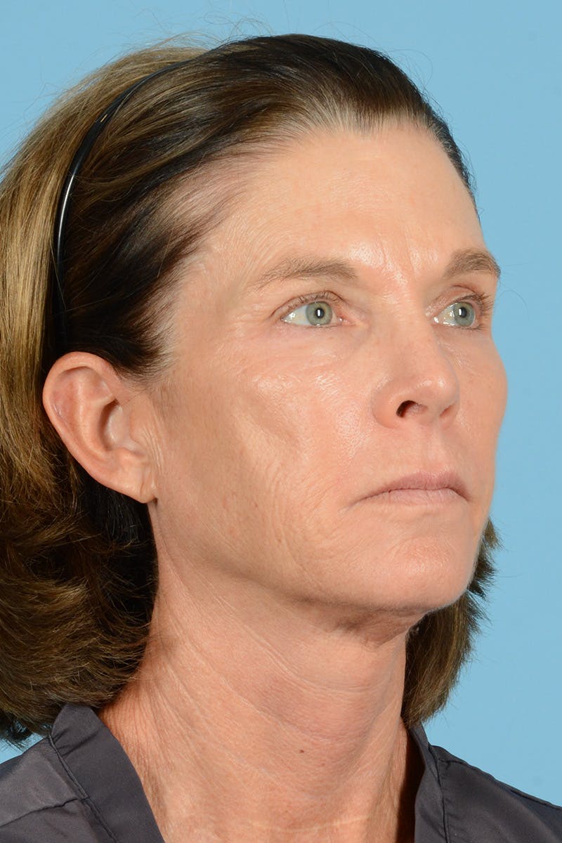 Facial Augmentation Before & After Gallery - Patient 394775 - Image 3