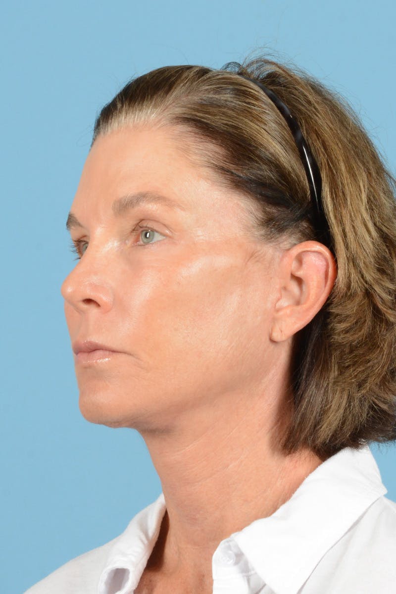 Facial Augmentation Before & After Gallery - Patient 394775 - Image 8