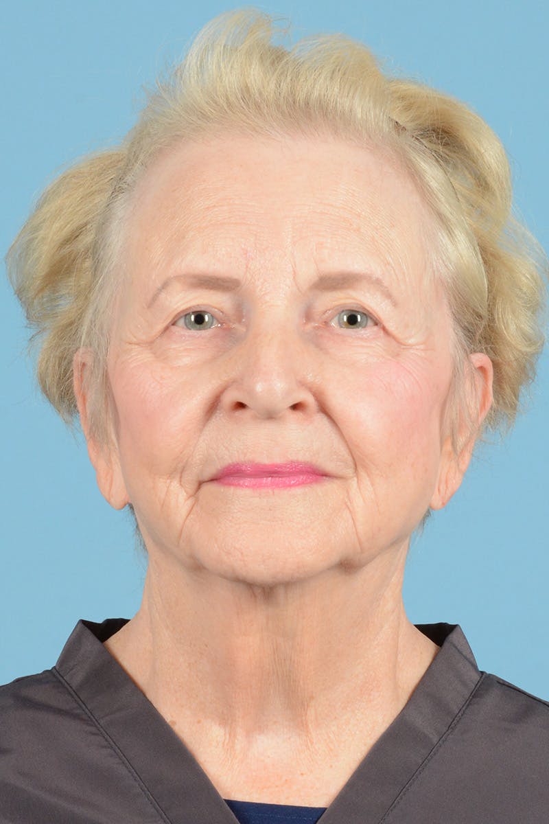 Facelift Before & After Gallery - Patient 219030 - Image 1