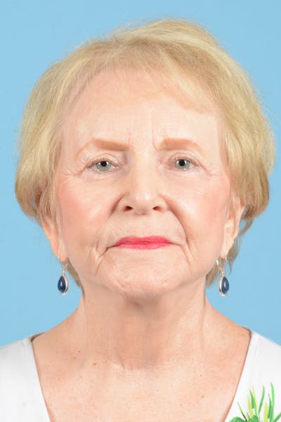 Facelift Before & After Gallery - Patient 219030 - Image 2