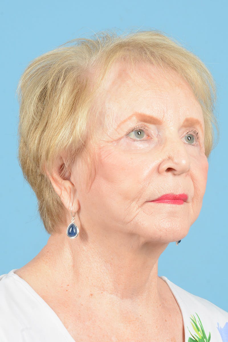 Facelift Before & After Gallery - Patient 219030 - Image 4