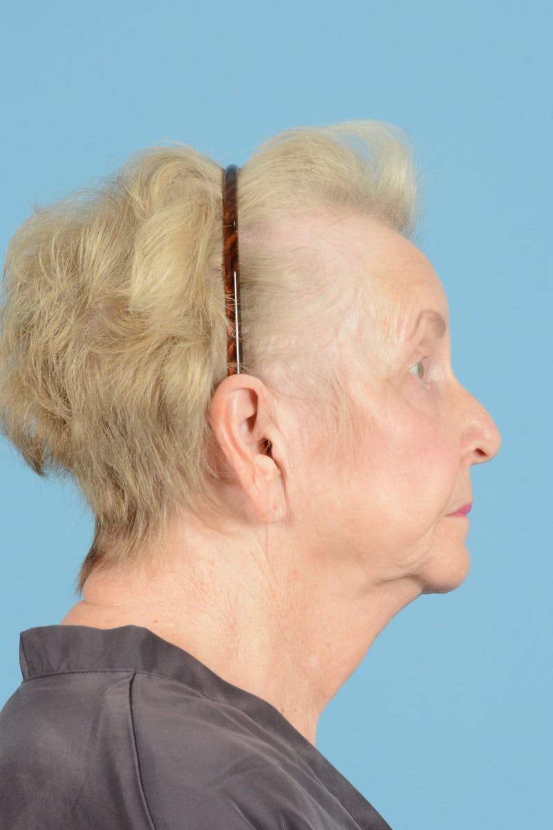 Neck Lift Before & After Gallery - Patient 405248 - Image 5