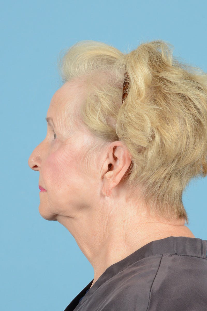 Facial Augmentation Before & After Gallery - Patient 253550 - Image 9