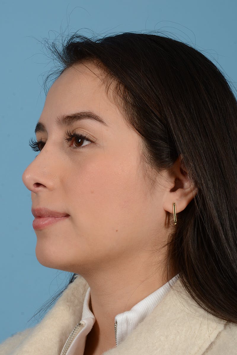 Rhinoplasty OLD Before & After Gallery - Patient 871075 - Image 6