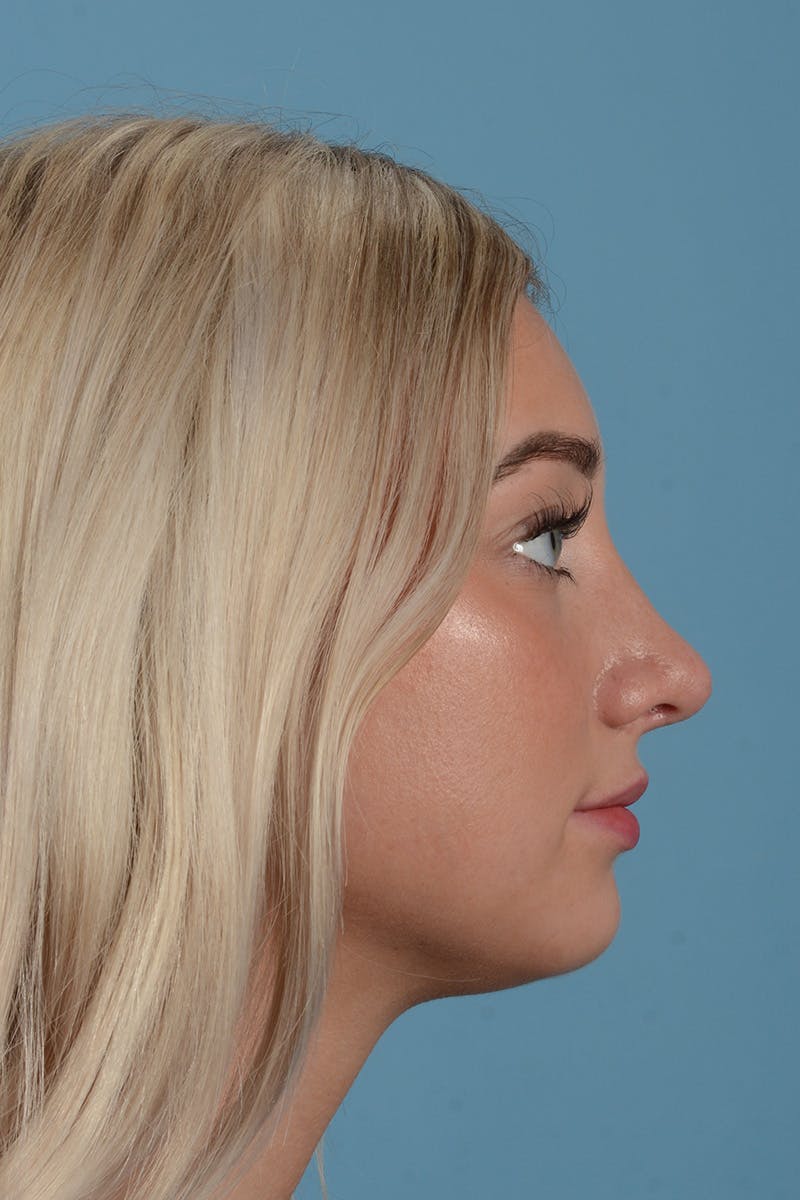 Rhinoplasty OLD Before & After Gallery - Patient 368652 - Image 6