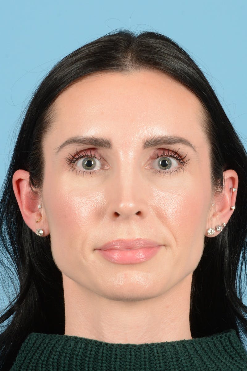 Rhinoplasty OLD Before & After Gallery - Patient 124077 - Image 2