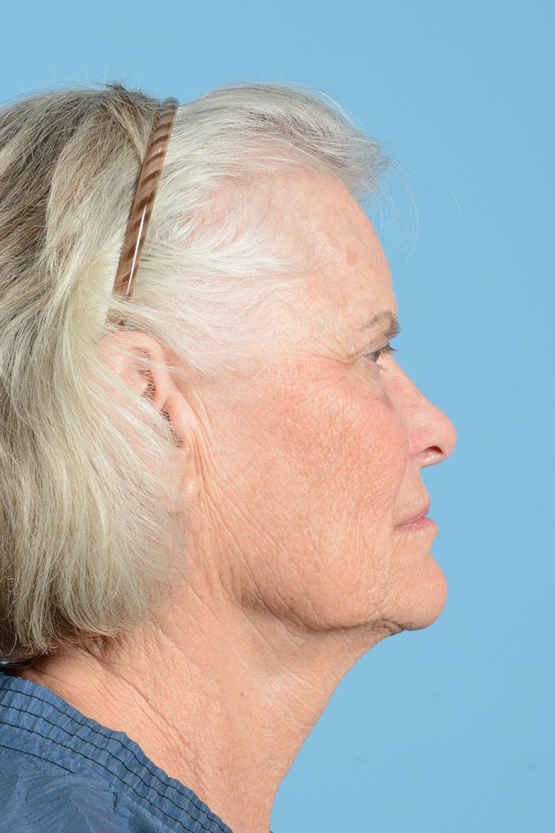 Endoscopic Brow Lift Before & After Gallery - Patient 193032 - Image 5