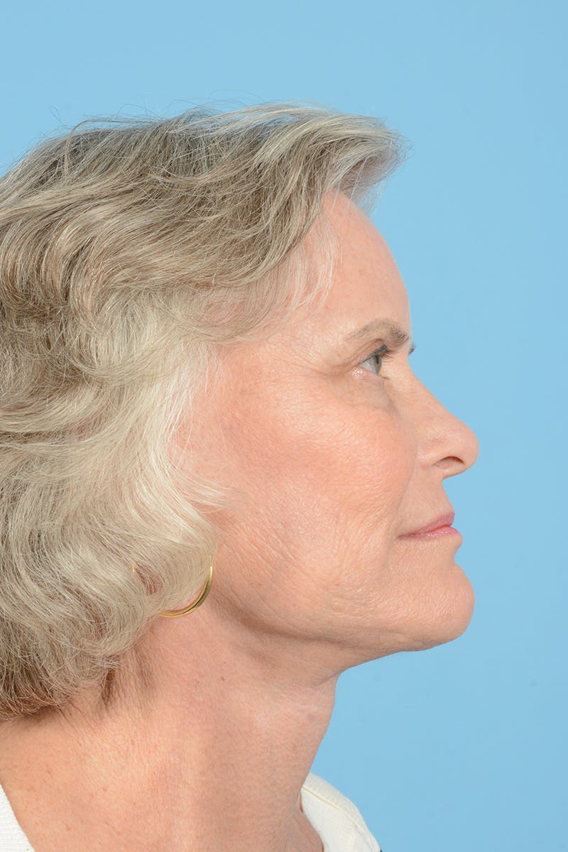Endoscopic Brow Lift Before & After Gallery - Patient 193032 - Image 6