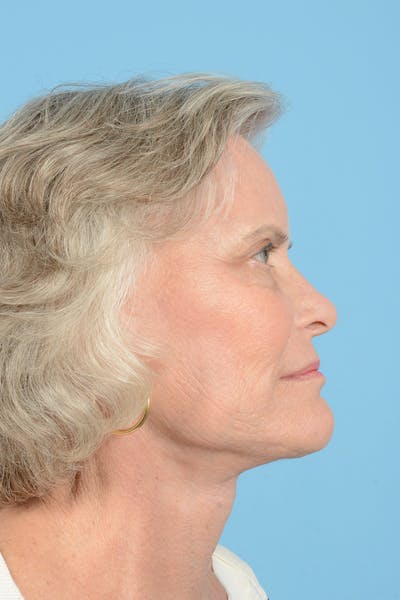 Endoscopic Brow Lift Before & After Gallery - Patient 193032 - Image 6