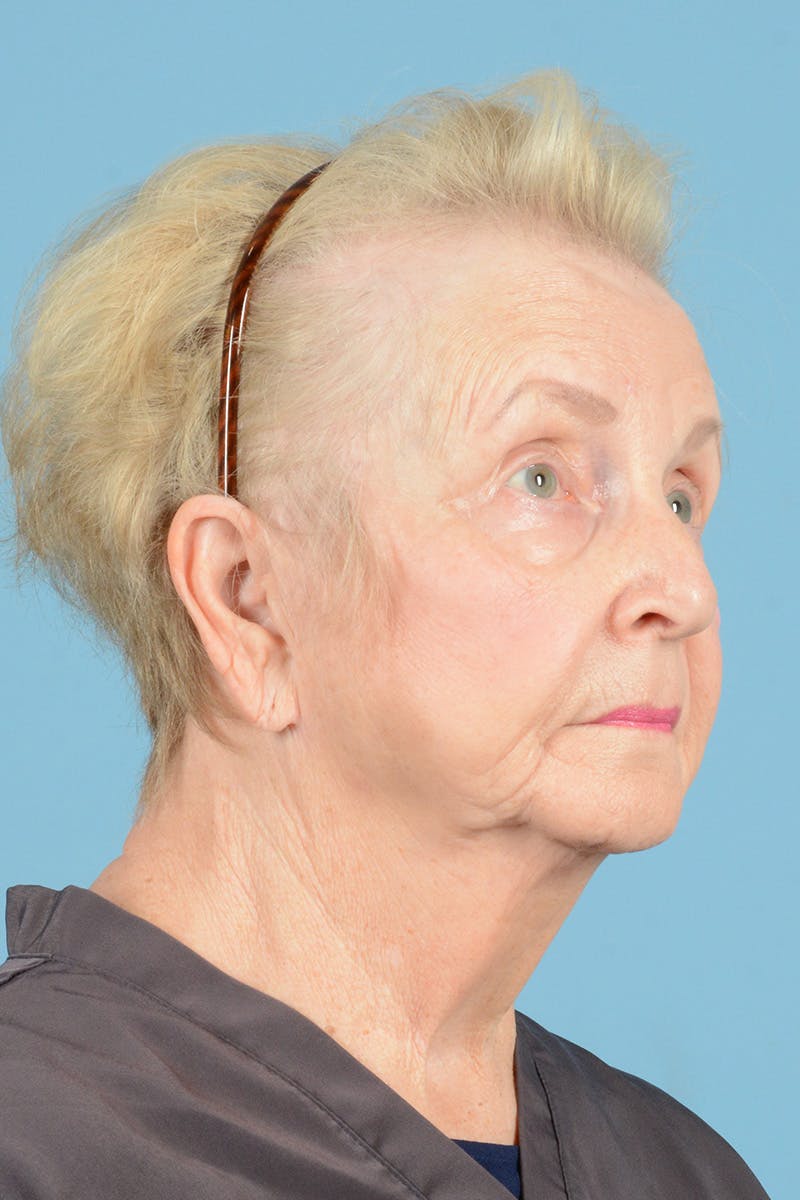 Endoscopic Brow Lift Before & After Gallery - Patient 216541 - Image 3