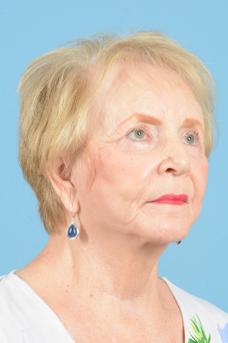 Endoscopic Brow Lift Before & After Gallery - Patient 216541 - Image 4