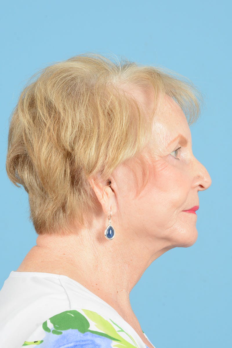 Endoscopic Brow Lift Before & After Gallery - Patient 216541 - Image 6