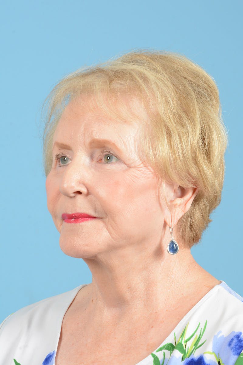 Endoscopic Brow Lift Before & After Gallery - Patient 216541 - Image 8