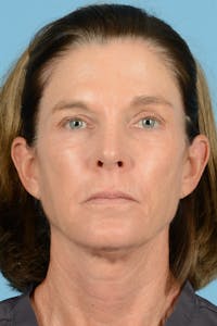 Endoscopic Brow Lift Before & After Gallery - Patient 169550 - Image 1