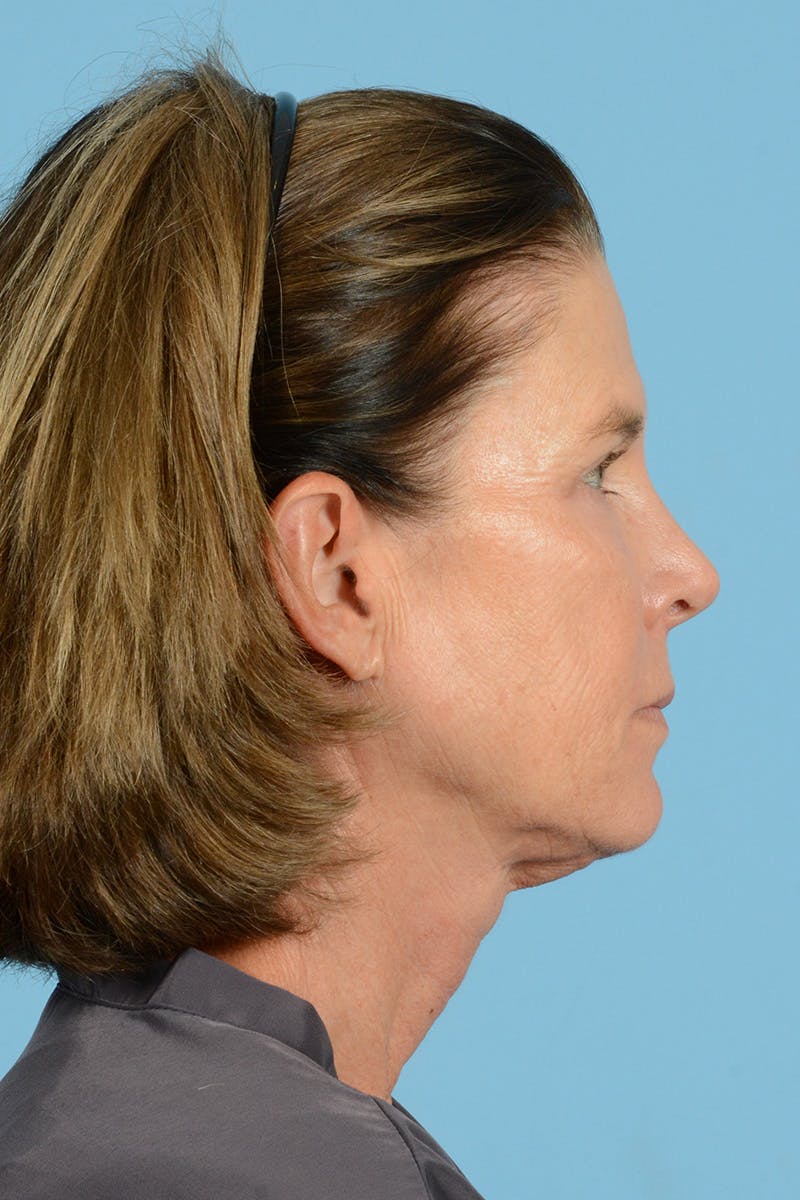 Endoscopic Brow Lift Before & After Gallery - Patient 169550 - Image 5