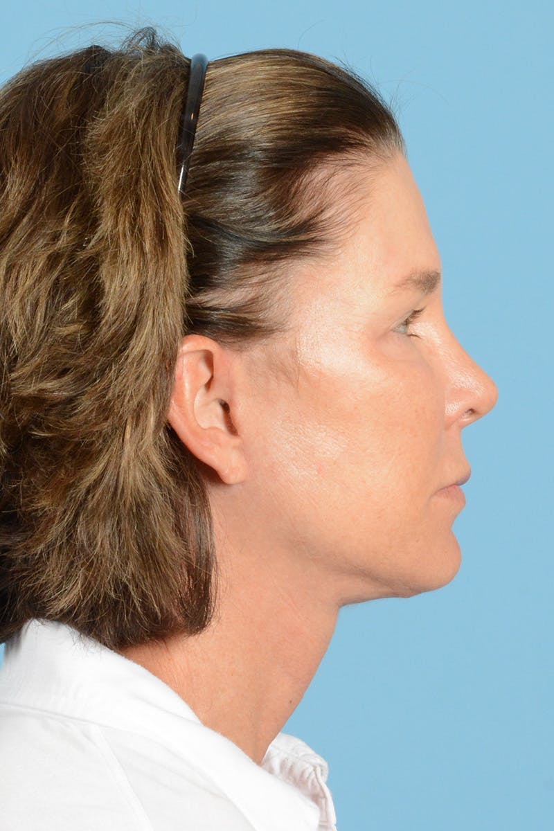 Endoscopic Brow Lift Before & After Gallery - Patient 169550 - Image 6