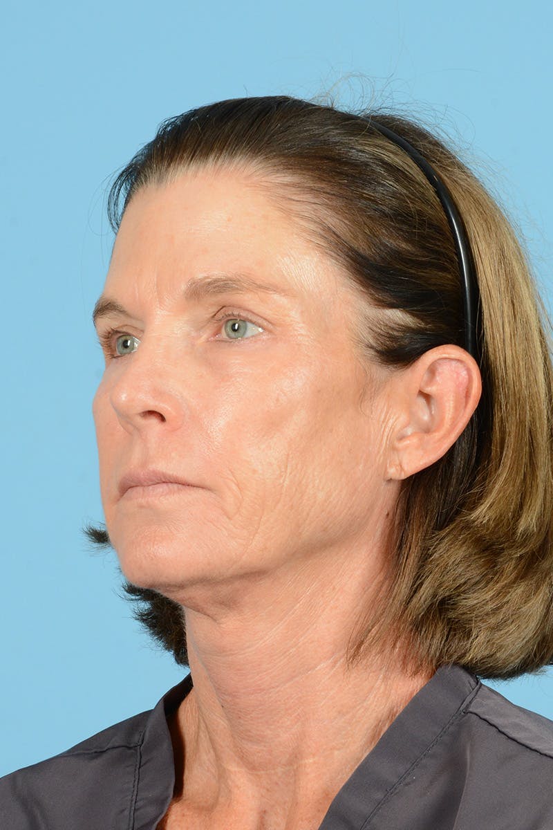 Endoscopic Brow Lift Before & After Gallery - Patient 169550 - Image 7