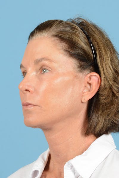 Endoscopic Brow Lift Before & After Gallery - Patient 169550 - Image 8