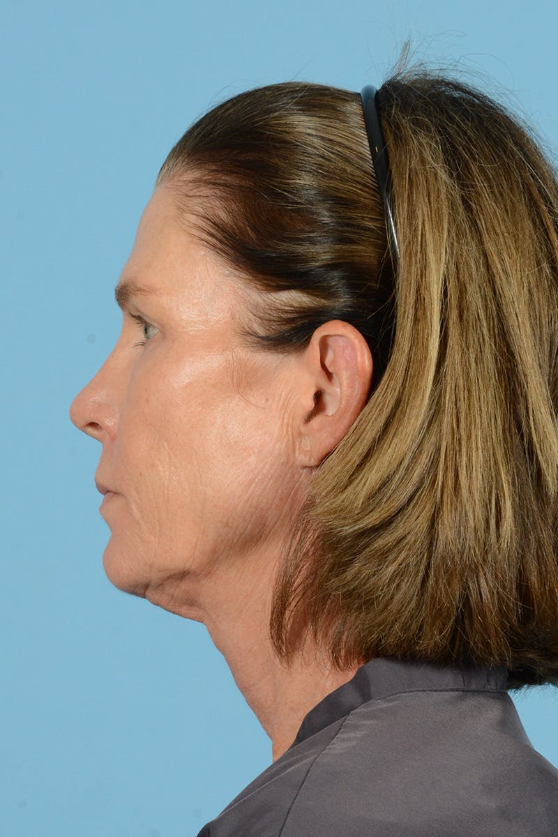 Endoscopic Brow Lift Before & After Gallery - Patient 169550 - Image 9